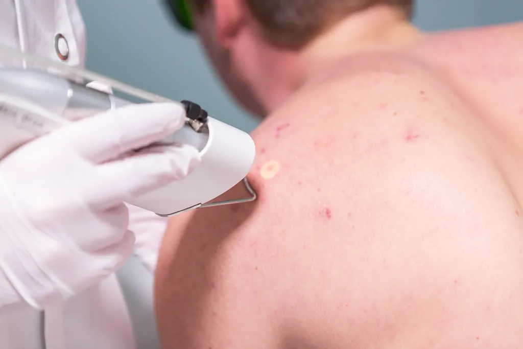 Behandeling van huidoneffenheden bij Dermavita Huidtherapie Zaandam