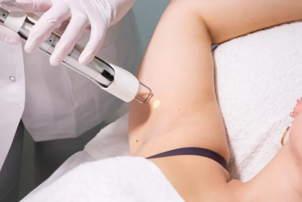 Laserontharing met de Duetto MT EVO bij Dermavita Huidtherapie Zaandam