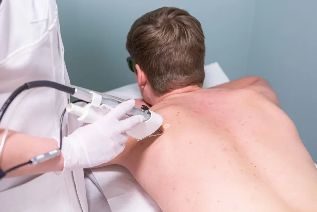 Littekentherapie met laser bij Dermavita Huidtherapie Zaandam