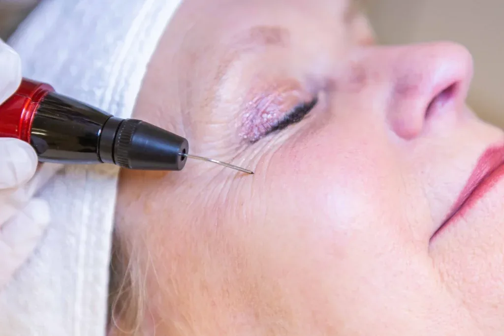Plasmage-behandeling voor ooglidcorrectie zonder snijden bij Dermavita Huidtherapie Zaandam