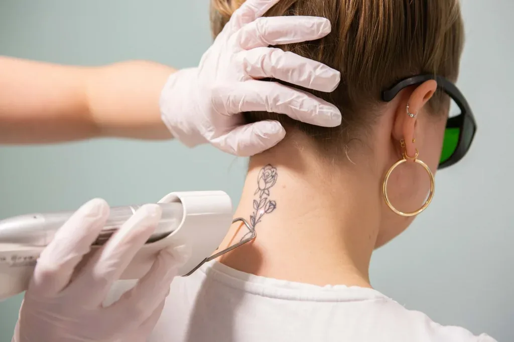 Laserbehandeling voor tatoeageverwijdering bij Dermavita Huidtherapie