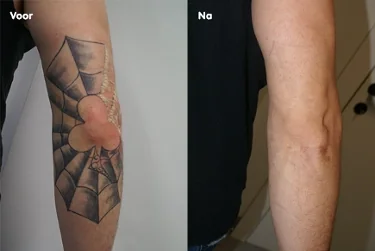 Voor en na: tatoeage verwijderd met de laser bij Dermavita Huidtherapie Zaandam