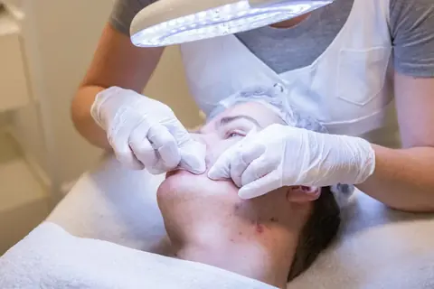 Acné bij Dermavita Huidtherapie Zaandam