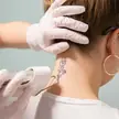 Tatoeage verwijdering bij Dermavita Huidtherapie Zaandam