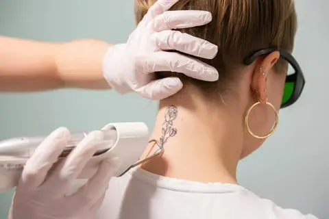 Tatoeage verwijdering bij Dermavita Huidtherapie Zaandam